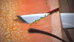 Surgical Site Infection