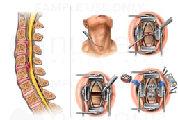 Cervical Spine Injury with Initial Surgical Repair