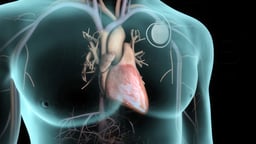 Implantable Cardioverter Defibrillator (ICD)