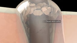 Clogged Hair Follicle with Dead Skin Cells Labeled