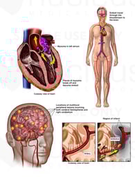 Embolization of an Atrial Myxoma with Resulting Brain Infarcts