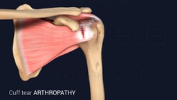 Cuff Tear Arthropathy of the Shoulder Joint