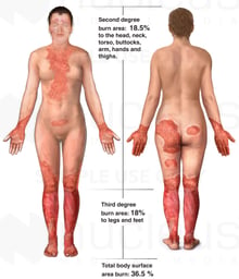 Severe Burn Injuries
