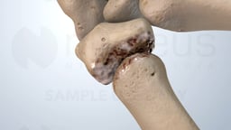 Understanding Osteoarthritis of the Thumb