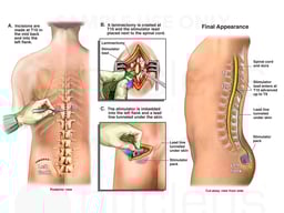 Placement of Thoracic Spinal Cord Stimulator