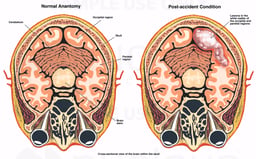 Brain Damage - Injury with Lesion in the Occipital and Parietal Regions