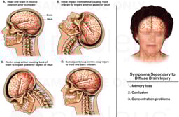 Traumatic Closed Head Injury