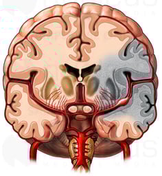 Cerebral Aneurysm, Cut-away View