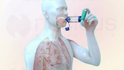 MDI with Spacer Delivering Medication to Lungs