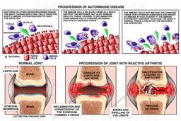 Auto-immune Disease with Formation of Reactive Arthritis