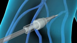 Intravenous (IV) Line in Arm Vein