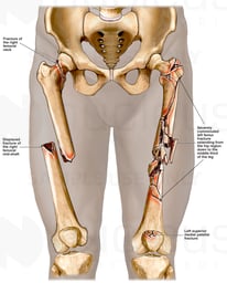 Severe Bilateral Femoral Fractures