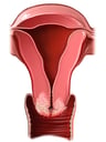 Cervical Cancer, Cut-away View