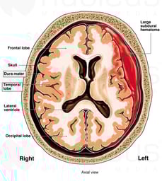 Worsening of Head Injury (Subdural Hematoma)