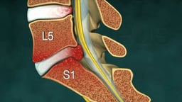 L5-S1 Disc Herniation plus Surgical Repair