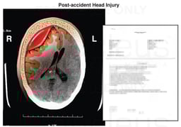 Post-accident Brain Injury with Page from Medical Records