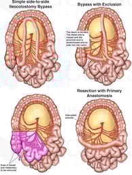 Operations for Regional Enteritis