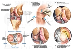 Right Knee Injuries with Arthroscopic Surgeries