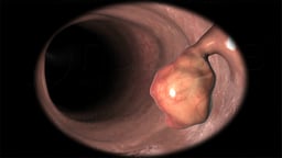 Endoscopic View of a Pedunculated Colonic Polyp