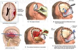 Brain Surgery - Severe Head Injury with Surgical Craniotomy