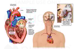 Progression of Endocarditis with Eventual Fatal Cerebral Artery Stroke