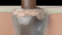 Clogged Hair Follicle