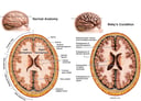 Central and Cortical Atrophy of the Brain