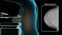 Mammogram Procedure with X-ray