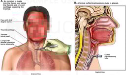 Emergency Tracheostomy Procedures