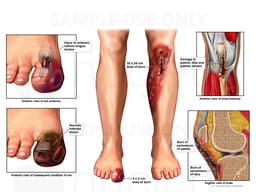 Burns of the Left Lower Leg and Right Great Toe
