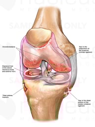 Right Knee Injuries