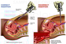 Laparoscopic Surgery - Iatrogenic Injury to the Abdominal Aorta
