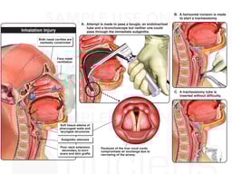 Tracheostomy Tube Placement