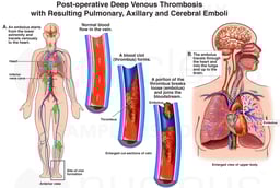 Post-operative Deep Venous Thrombosis with Resulting Pulmonary, Axillary and Cerebral Emboli