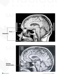 CT Scan Evidence Before and After Central Pontine Myelolysis