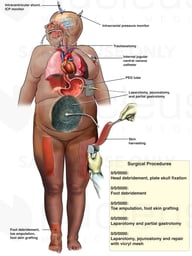 Multiple Surgical Procedures