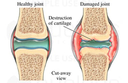 Synovial Joint Showing Arthritis