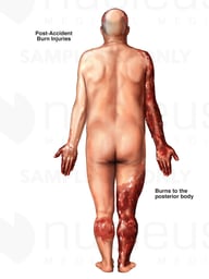 Male Figure with Post-accident Burn Injuries