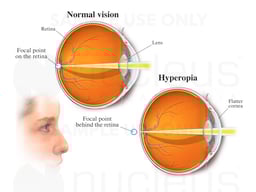 Hyperopia