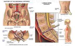 Iatrogenic Injury to Iliac Artery During L5-S1 Lumbar Spine Surgery