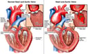 Incomplete Closure of Aortic Semilunar Valve