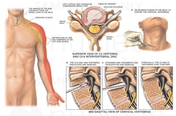 C5-6 Disc Herniation with Spinal Nerve Root Compression and Resultant Arm Pain