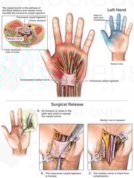 Carpal Tunnel Syndrome and Surgical Release: Left Hand