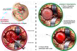 Brain Surgery - Incorrect vs. Correct Surgical Treatments for Cerebral Aneurysm