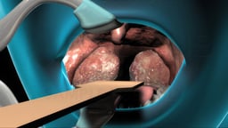 Tonsillectomy and Adenoidectomy