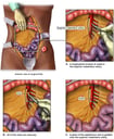 Blockage of the Superior Mesenteric Artery with Attempted Surgical Repair