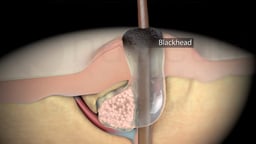 Types of Acne: Blackhead