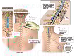 Placement of Spinal Cord Stimulator