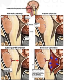 Progression of the Intracranial Hemorrhage