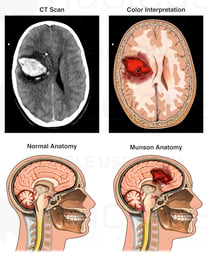 Intracranial Hemorrhage with Resulting Uncal Herniation